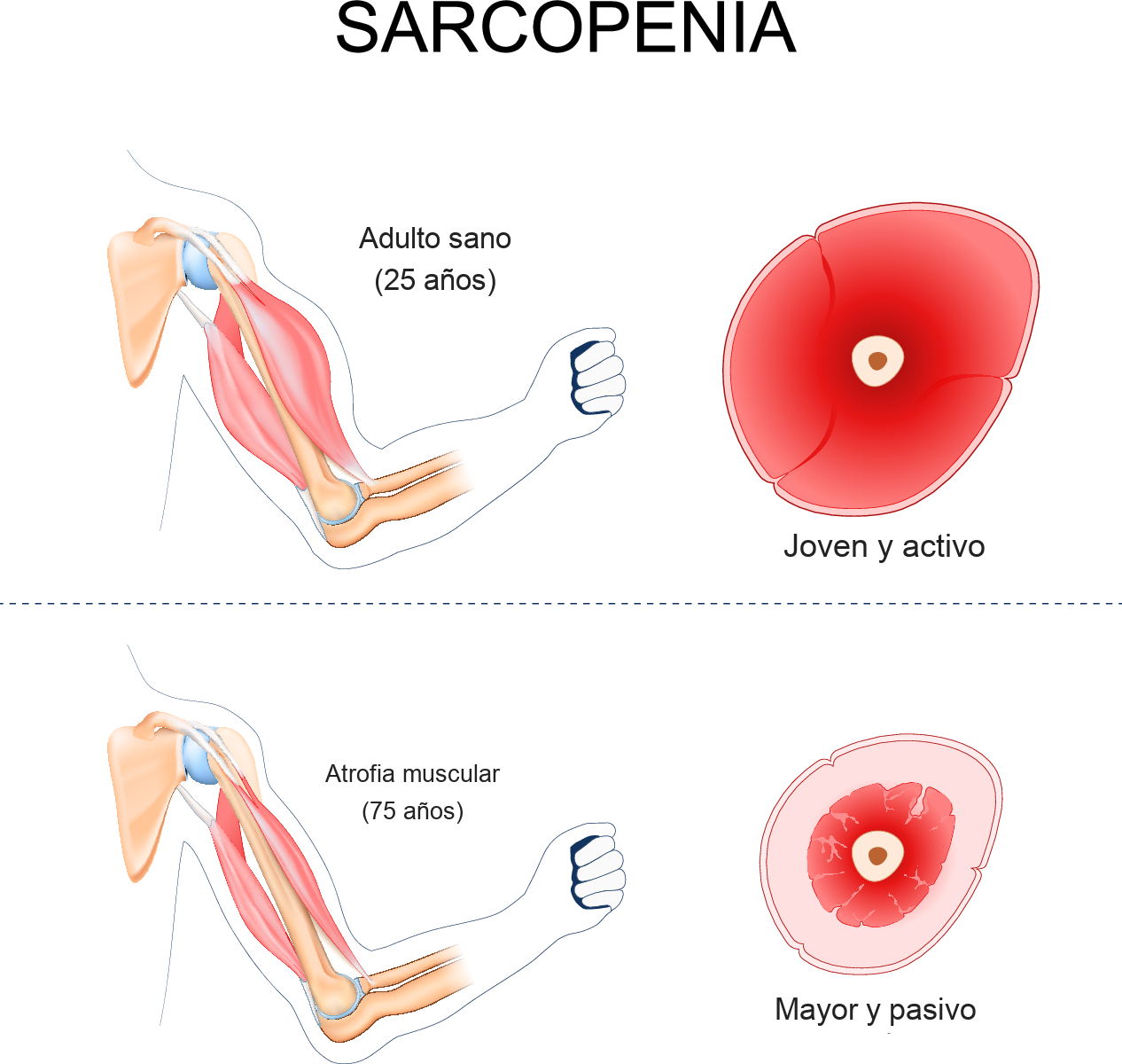 Sarcopenia: músculo de un adulto sano (25 años) frente a atrofia muscular (75 años)