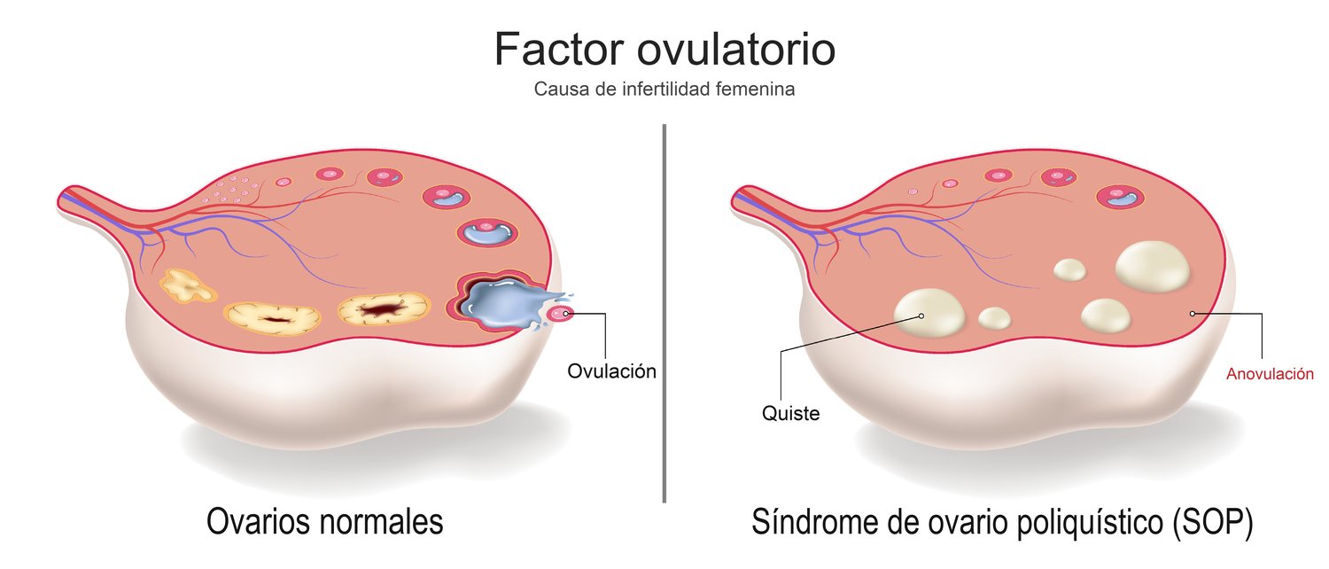 Diagrama de ovario normal frente a ovario poliqu&iacute;stico